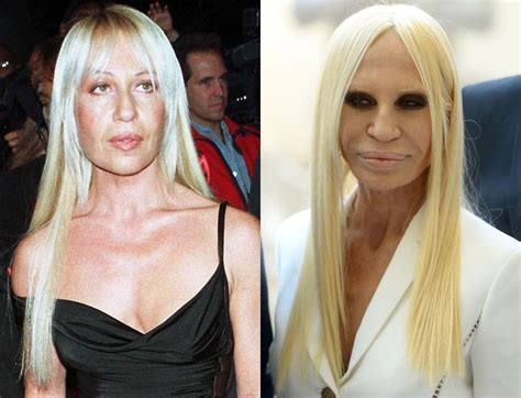 donatelka versace|Donatella Versace before and after surgery.